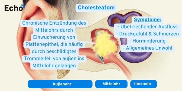 Rauschen Im Ohr Bei Erkältung 13 häufigste Ohrenerkrankungen👂🏼 [Ursachen, Symptome & Tipps] - Echo